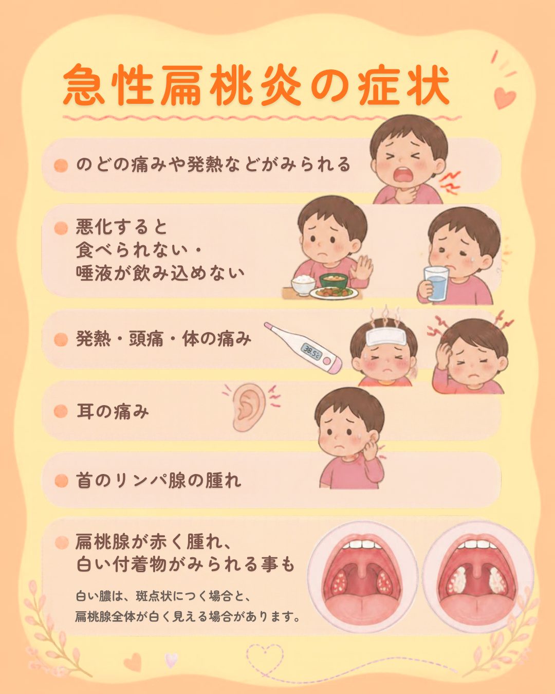 子どもの急性扁桃炎でみられるのどの痛み、発熱、耳の痛み、扁桃の腫れなどの症状