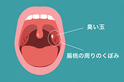 扁桃栓