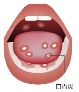 ヘルペス 喉 の 奥